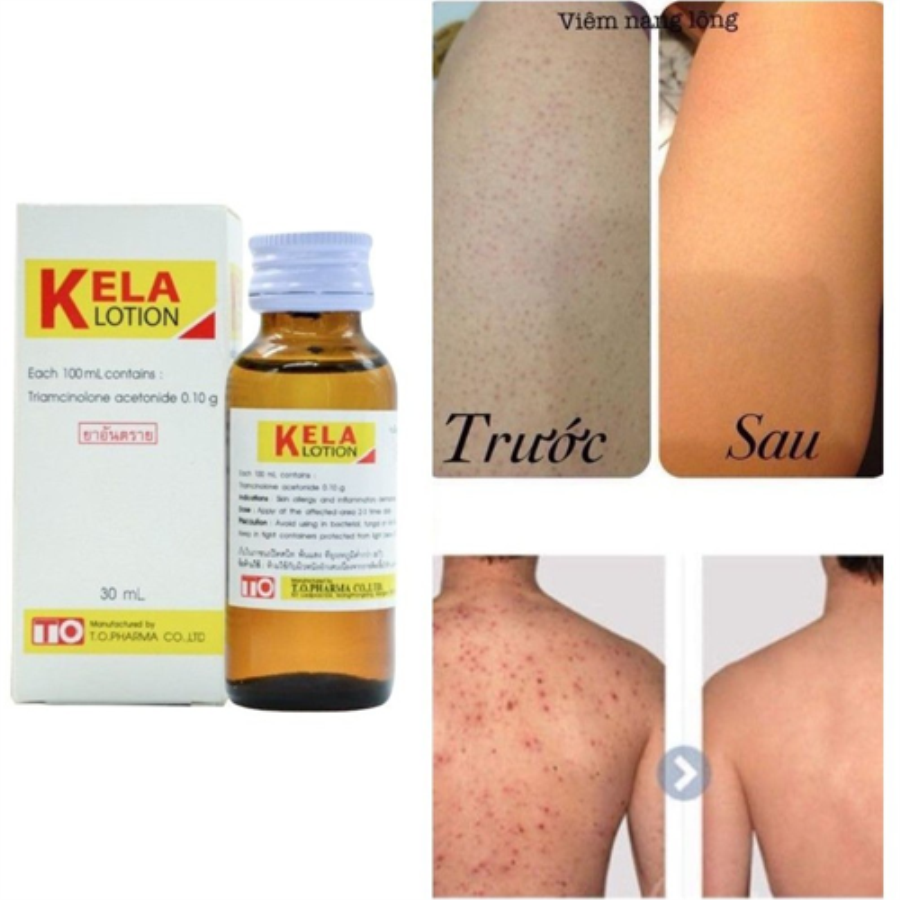 Kela Lotion Đặc Trị Viêm Lỗ Chân Lông Thái Lan Sản phẩm khác-1