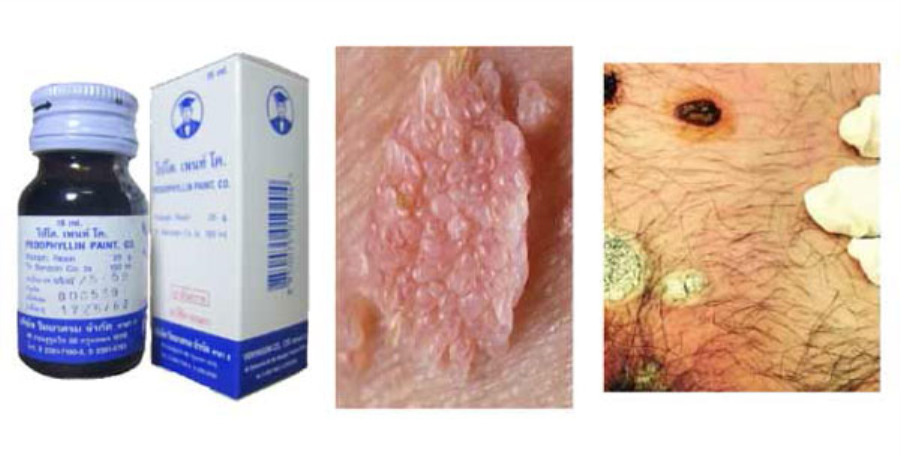 Thuốc Bôi Trị Sùi mào gà, Mụn cóc, mụn vùng kín Podophyllin Thái Lan Phong the-1