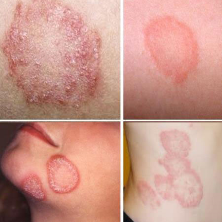 Thuốc Đặc Trị Lang Ben, Nấm, Ngứa Nizoral Thái Lan Thuốc Đặc Trị Lang Ben-1