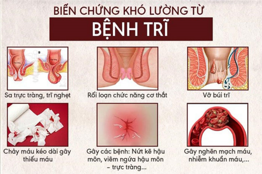 Kem Bôi Trĩ Doproct Thái Lan Sản phẩm khác-1