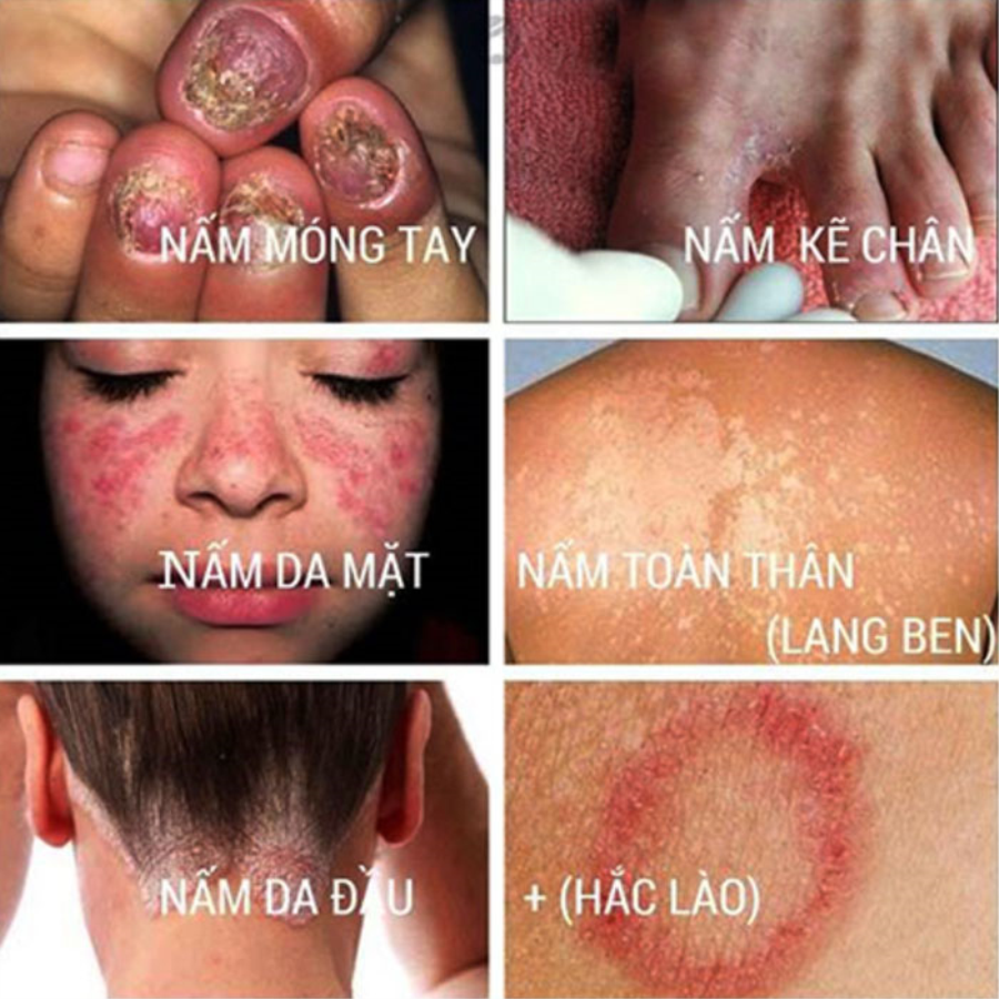 Kem Trị Nấm Móng Clothasone D Cream 15gr Thái Lan Thuốc Đặc Trị Lang Ben-2