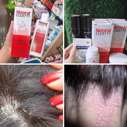 Dầu Gội Trị Gàu, Nấm Nizoral Shampoo Thái Lan Dầu gội-1